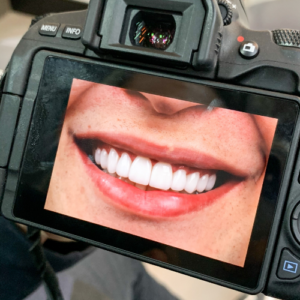 Clareamento Dental