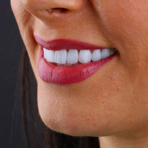 Implante Dentário